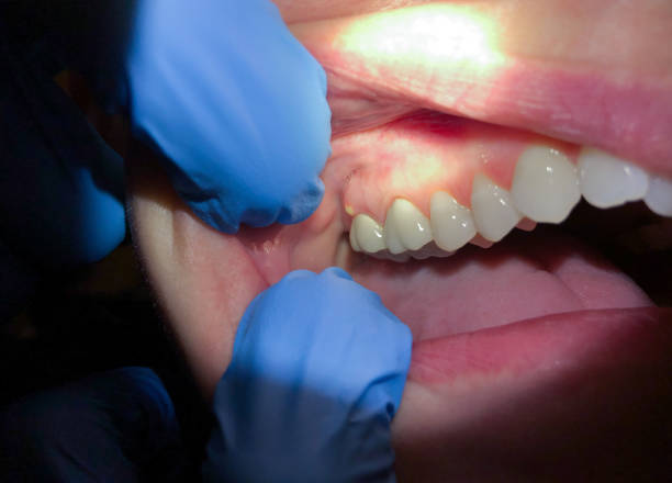 Best Emergency Treatment for Oral Infections in London, OH